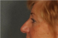 Eyelid Surgery Before Photo by Ellen Janetzke, MD; Bloomfield Hills, MI - Case 30789