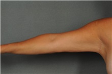 Arm Lift After Photo by Ellen Janetzke, MD; Bloomfield Hills, MI - Case 30790