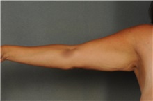 Arm Lift Before Photo by Ellen Janetzke, MD; Bloomfield Hills, MI - Case 30790