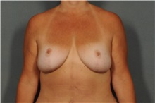 Breast Reduction After Photo by Ellen Janetzke, MD; Bloomfield Hills, MI - Case 30792
