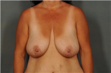 Breast Reduction Before Photo by Ellen Janetzke, MD; Bloomfield Hills, MI - Case 30792