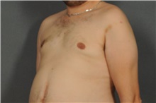 Male Breast Reduction After Photo by Ellen Janetzke, MD; Bloomfield Hills, MI - Case 30793
