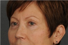 Eyelid Surgery After Photo by Ellen Janetzke, MD; Bloomfield Hills, MI - Case 30795