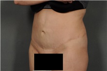 Tummy Tuck After Photo by Ellen Janetzke, MD; Bloomfield Hills, MI - Case 30896