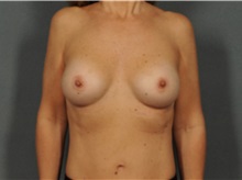 Breast Augmentation After Photo by Ellen Janetzke, MD; Bloomfield Hills, MI - Case 31434