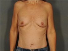 Breast Augmentation Before Photo by Ellen Janetzke, MD; Bloomfield Hills, MI - Case 31434