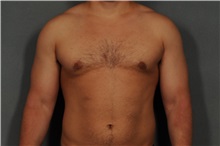 Male Breast Reduction After Photo by Ellen Janetzke, MD; Bloomfield Hills, MI - Case 31686