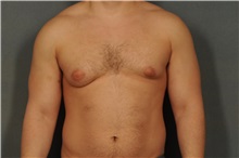 Male Breast Reduction Before Photo by Ellen Janetzke, MD; Bloomfield Hills, MI - Case 31686