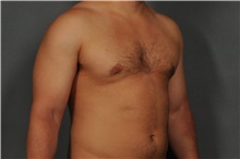 Male Breast Reduction After Photo by Ellen Janetzke, MD; Bloomfield Hills, MI - Case 31686