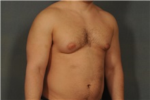 Male Breast Reduction Before Photo by Ellen Janetzke, MD; Bloomfield Hills, MI - Case 31686