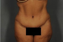 Tummy Tuck After Photo by Ellen Janetzke, MD; Bloomfield Hills, MI - Case 31931
