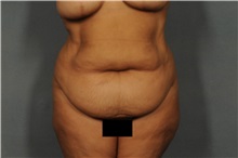 Tummy Tuck Before Photo by Ellen Janetzke, MD; Bloomfield Hills, MI - Case 31931