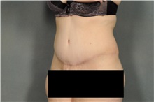 Tummy Tuck After Photo by Ellen Janetzke, MD; Bloomfield Hills, MI - Case 32603