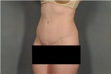 Tummy Tuck After Photo by Ellen Janetzke, MD; Bloomfield Hills, MI - Case 32604