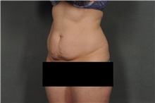 Tummy Tuck Before Photo by Ellen Janetzke, MD; Bloomfield Hills, MI - Case 32604