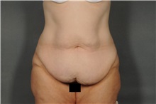 Tummy Tuck Before Photo by Ellen Janetzke, MD; Bloomfield Hills, MI - Case 32605