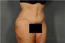 Tummy Tuck After Photo by Ellen Janetzke, MD; Bloomfield Hills, MI - Case 32605