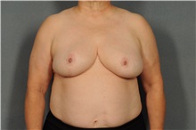 Breast Reduction After Photo by Ellen Janetzke, MD; Bloomfield Hills, MI - Case 33135