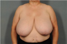 Breast Reduction Before Photo by Ellen Janetzke, MD; Bloomfield Hills, MI - Case 33135