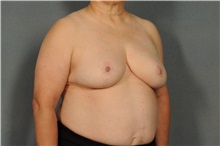 Breast Reduction After Photo by Ellen Janetzke, MD; Bloomfield Hills, MI - Case 33135