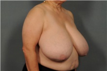 Breast Reduction Before Photo by Ellen Janetzke, MD; Bloomfield Hills, MI - Case 33135