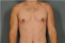 Male Breast Reduction After Photo by Ellen Janetzke, MD; Bloomfield Hills, MI - Case 33137