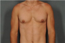 Male Breast Reduction Before Photo by Ellen Janetzke, MD; Bloomfield Hills, MI - Case 33137