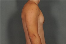 Male Breast Reduction After Photo by Ellen Janetzke, MD; Bloomfield Hills, MI - Case 33137