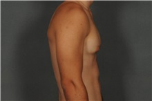Male Breast Reduction Before Photo by Ellen Janetzke, MD; Bloomfield Hills, MI - Case 33137