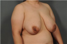Breast Reduction Before Photo by Ellen Janetzke, MD; Bloomfield Hills, MI - Case 33141