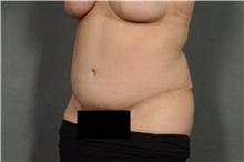 Tummy Tuck After Photo by Ellen Janetzke, MD; Bloomfield Hills, MI - Case 33142