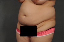 Tummy Tuck Before Photo by Ellen Janetzke, MD; Bloomfield Hills, MI - Case 33142