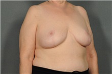 Breast Reduction After Photo by Ellen Janetzke, MD; Bloomfield Hills, MI - Case 33144
