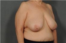 Breast Reduction Before Photo by Ellen Janetzke, MD; Bloomfield Hills, MI - Case 33144