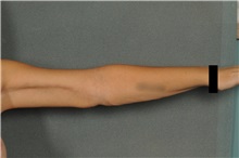 Arm Lift After Photo by Ellen Janetzke, MD; Bloomfield Hills, MI - Case 33364