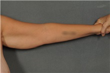 Arm Lift Before Photo by Ellen Janetzke, MD; Bloomfield Hills, MI - Case 33364