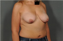Breast Lift Before Photo by Ellen Janetzke, MD; Bloomfield Hills, MI - Case 33365