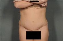 Tummy Tuck After Photo by Ellen Janetzke, MD; Bloomfield Hills, MI - Case 33895