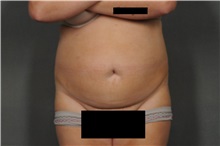 Tummy Tuck Before Photo by Ellen Janetzke, MD; Bloomfield Hills, MI - Case 33895