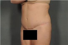 Tummy Tuck After Photo by Ellen Janetzke, MD; Bloomfield Hills, MI - Case 33895