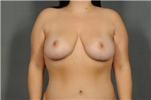 Breast Reduction After Photo by Ellen Janetzke, MD; Bloomfield Hills, MI - Case 33896