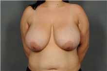 Breast Reduction Before Photo by Ellen Janetzke, MD; Bloomfield Hills, MI - Case 33896