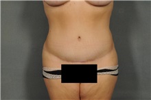 Tummy Tuck After Photo by Ellen Janetzke, MD; Bloomfield Hills, MI - Case 33897