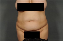 Tummy Tuck Before Photo by Ellen Janetzke, MD; Bloomfield Hills, MI - Case 33897