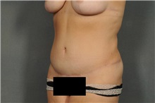 Tummy Tuck After Photo by Ellen Janetzke, MD; Bloomfield Hills, MI - Case 33897