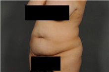 Tummy Tuck Before Photo by Ellen Janetzke, MD; Bloomfield Hills, MI - Case 33897