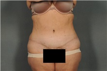 Tummy Tuck After Photo by Ellen Janetzke, MD; Bloomfield Hills, MI - Case 33898