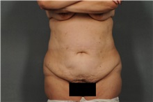 Tummy Tuck Before Photo by Ellen Janetzke, MD; Bloomfield Hills, MI - Case 33898
