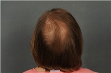 Hair Transplant After Photo by Ellen Janetzke, MD; Bloomfield Hills, MI - Case 33899