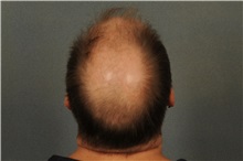 Hair Transplant Before Photo by Ellen Janetzke, MD; Bloomfield Hills, MI - Case 33899
